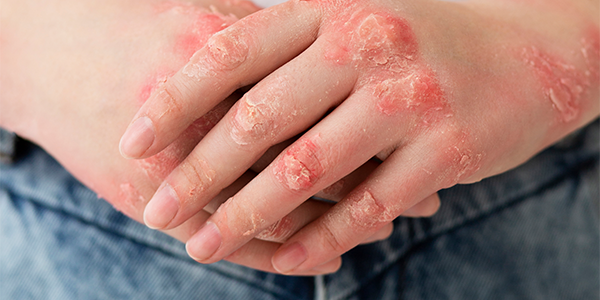 Leia mais sobre o artigo Artrite Psoriásica